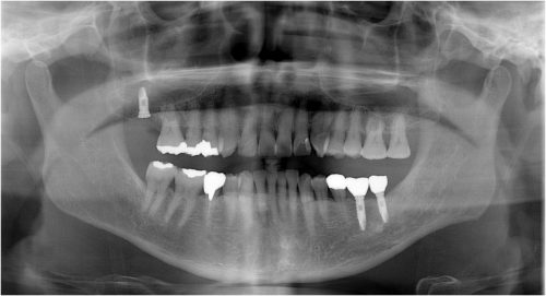 %e7%ab%9c%e7%94%b07-%e5%8f%b3%e4%b8%8a7%e5%9f%8b%e5%85%a5%e5%be%8c%e3%80%80